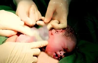 Cực hiếm: Bé gái chào đời với 9 vòng dây rốn quấn cổ