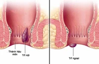 Ngồi lâu có phải nguyên nhân gây bệnh trĩ?