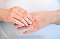 6 triệu chứng ngứa da cảnh báo bệnh tiểu đường