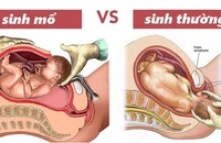 Mất con vì chọn ngày giờ đẹp để sinh mổ