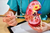 Ăn gì để chữa bệnh sỏi thận?