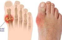 Không chỉ thịt đỏ, đây là những thực phẩm cực hại cho người bệnh gút