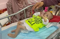 Ở Gaza, nạn đói và những chiếc xương sườn của trẻ em