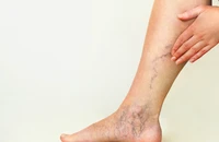 Người bị suy giãn tĩnh mạch chân có nên đi bộ nhiều?