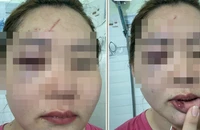 Thầy giáo ở Đắk Lắk thừa nhận hành vi đánh vợ nhập viện