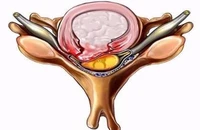 Thoát vị đĩa đệm và những hậu quả khó lường