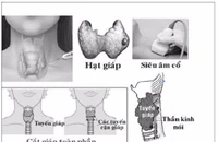 Ai dễ bị ung thư tuyến giáp?
