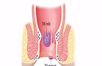 Nhận biết bệnh trĩ