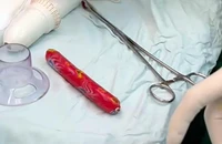 Thử 'cảm giác lạ', nam thanh niên bị kẹt cây xúc xích trong hậu môn