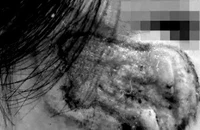 Bôi thuốc chứa axit trị nám, nhiều người bị nhiễm trùng, sẹo xấu