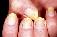 Màu sắc, hình dáng móng tay nói gì về sức khỏe của bạn?