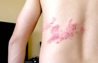 Bệnh zona dễ nhầm lẫn với bệnh nào?