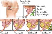 Ung thư tuyến tiền liệt sống được bao lâu?