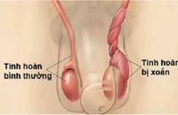 Bé trai phải cắt bỏ tinh hoàn sau cơn đau 5 ngày nhưng cố nhịn