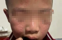 Nhiều học sinh dị ứng, sưng mắt sau khi trường phun thuốc diệt muỗi