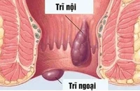 Bỗng dưng đi cầu ra máu có phải bị bệnh trĩ?