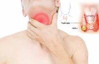 Các dấu hiệu điển hình của ung thư tuyến giáp