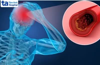 Xuất huyết não có thể hồi phục được không?