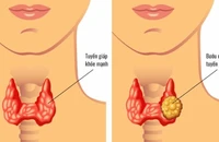 Bác sĩ ơi, cắt tuyến giáp có còn nói được nữa không?