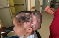 Cô gái biến chứng khuyết sọ sau cấy mỡ tự thân vào thái dương