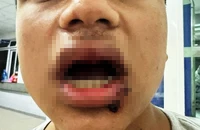 Xác định được nhóm người hành hung, làm gãy 4 cái răng của nam sinh