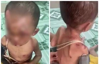 Bé trai hơn 1 tuổi nghi bị bạo hành, người dân trình báo công an