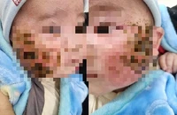 Đắp lá cây chữa viêm da, bé trai bị loét hai bên má