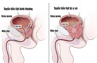 Tuyến tiền liệt bình thường và tuyến tiền liệt bị u xơ. Ảnh: Internet