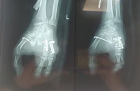 Biến ngón chân thành ngón tay cho bệnh nhân bị tai nạn máy xay thịt 