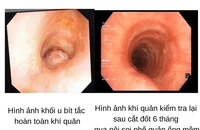 Bị khối u hiếm bít khí quản, cô gái suy hô hấp nguy kịch