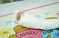 Báo động đỏ nối bàn tay đứt lìa cho bé trai 5 tuổi bị tai nạn giao thông