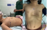 Bé 3 tuổi lõm ngực nghiêm trọng, phải đặt thanh nâng 2 năm