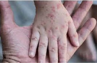 Có 18/20 ca mắc đậu mùa khỉ điều trị tại TP.HCM nhiễm HIV