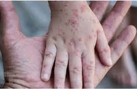Đồng Nai, Bình Dương có ca đậu mùa khỉ, Bộ Y tế khuyến cáo gì?