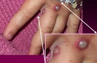 TP.HCM đã ghi nhận 19 ca mắc đậu mùa khỉ
