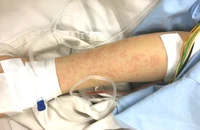 Người phụ nữ bị phản vệ độ 3 sau tiêm vaccine 