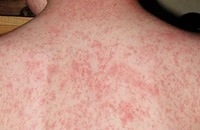 Khi nào trẻ tiêm mũi vaccine sởi đầu tiên?