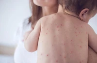 TP.HCM ghi nhận 2 ca bệnh sởi biến chứng viêm phổi