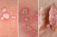 Bị sùi mào gà có vô sinh không?
