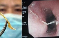 Hóc dị vật, tưởng bình thường mà nguy hiểm khôn lường