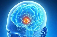Bệnh ung thư não diễn viên Quý Bình mắc phải nguy hiểm ra sao?