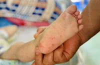 Tay chân miệng ở TP.HCM tăng cao, thêm 2 ca tử vong 