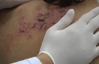 Bị zona thần kinh, ba tôi đòi đưa đến thầy lang vẽ 'bùa khoán'
