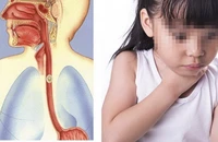 Bé trai 5 tuổi suýt thủng thực quản vì hóc xương cá ba sa
