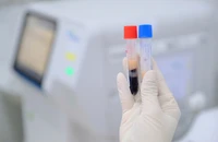 Nam thanh niên có huyết thanh đục trắng như sữa hiếm gặp