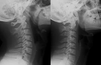 Đau cổ vai gáy kéo dài, đi khám phát hiện hội chứng cổ thẳng nguy hiểm