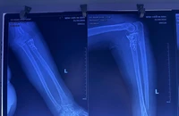 Phối hợp chuyên khoa sâu cứu bệnh nhân gãy xương khỏi 'tam chứng đau khổ'