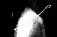 Cụ ông bị cây sắt đâm vào cổ, xuyên xuống phổi