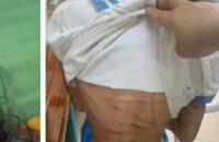 Công an vào cuộc vụ bé gái lớp 5 nghi bị cha dượng bạo hành