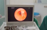 Ho suốt ba năm trời mới phát hiện bị mắc xương cá